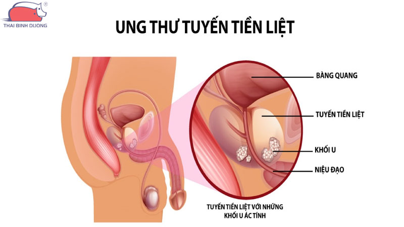 Ung thư tuyến tiền liệt